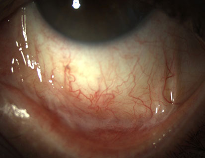 CICATRIZING CONJUNCTIVITIS – Pancornea